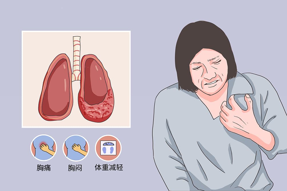 间皮瘤：病因、症状、诊断与治疗全解析