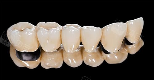 烤瓷牙材质大揭秘：种类、价格、优缺点全解析