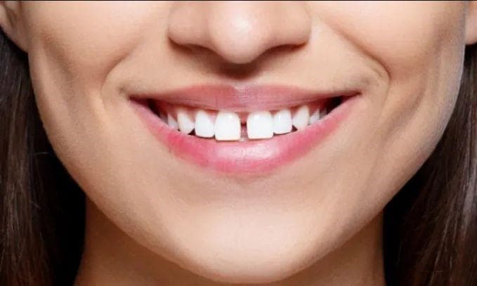 怎么让牙缝“合”好如初？