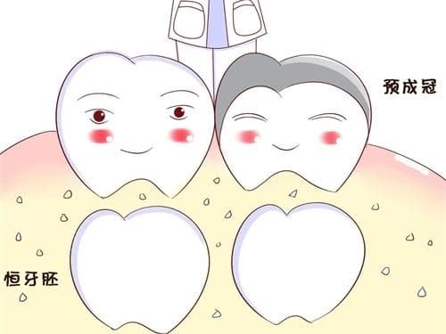 儿童预成冠有必要做吗?什么情况下需要做儿童预成冠以及儿童预成冠利弊分析!