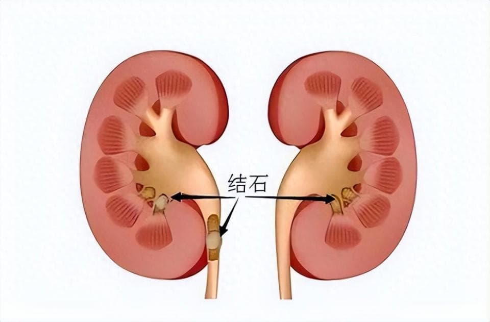 出现这些症状，小心肾结石！查出肾结石，正确应对做好6点！