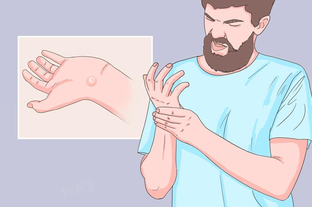 腱鞘囊肿手腕最佳治疗方法