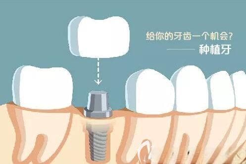 种植牙手术过程详解：从术前检查到术后护理