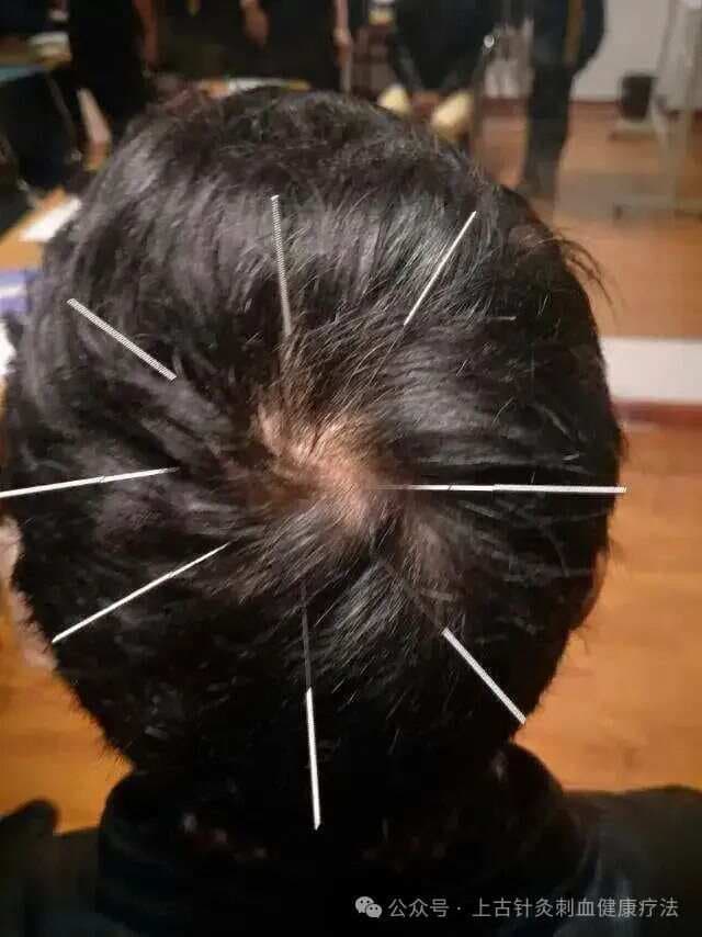 针灸治疗各种头痛的方法（干货）