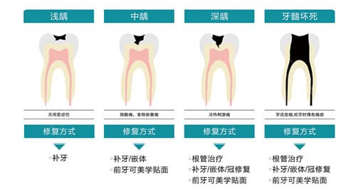 龋齿从一度到五度：看似健康的牙齿可能暗藏危机