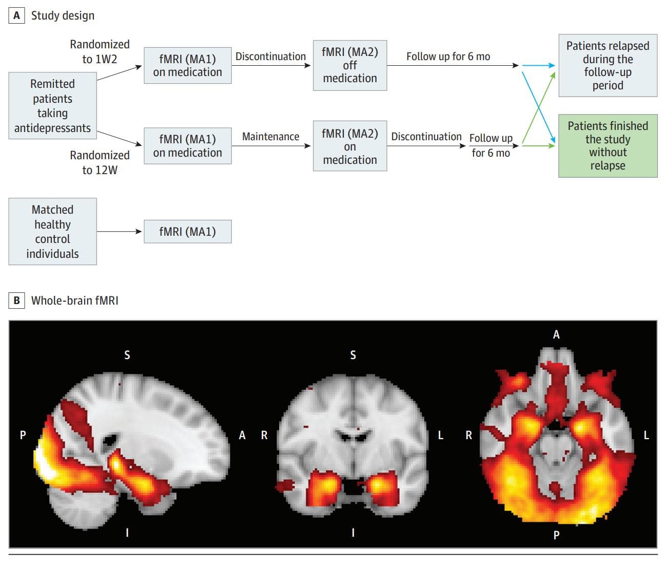 JAMA Psychiatry：杏仁核反应性、抗抑郁药停药与复发：一项纵向研究