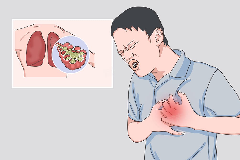 肺部长期有炎症怎么办