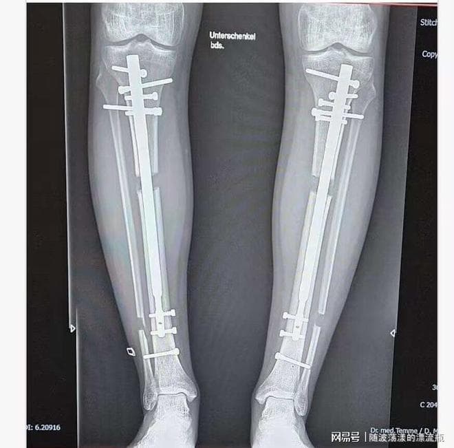 德国男子通过折断自己的腿骨增高20cm，引发舆论哗然