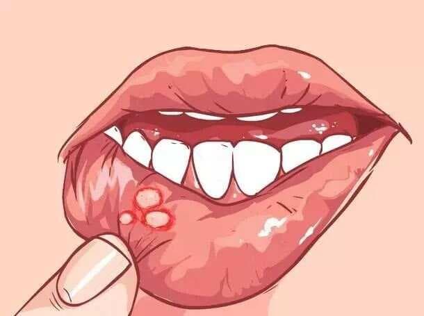 【药师说药】嘶~痛！口腔溃疡反复发作怎么破？最全用药指南→