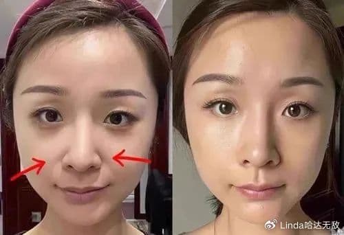 面部抗衰指南：玻尿酸、少女针、童颜针、胶原蛋白有何区别？