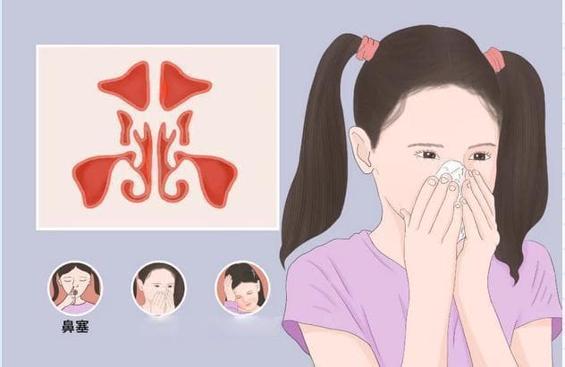 鼻塞流涕、头面胀痛、嗅觉减退？一文详解慢性鼻窦炎