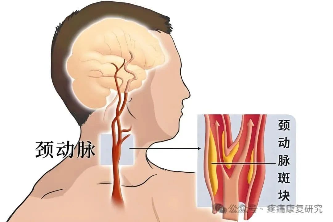 转动脖子有响声？四类人群需当心，附自我检查法