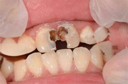 牙齿有洞但不痛要补吗？我来告诉你牙窟窿不补后果附修复方法！