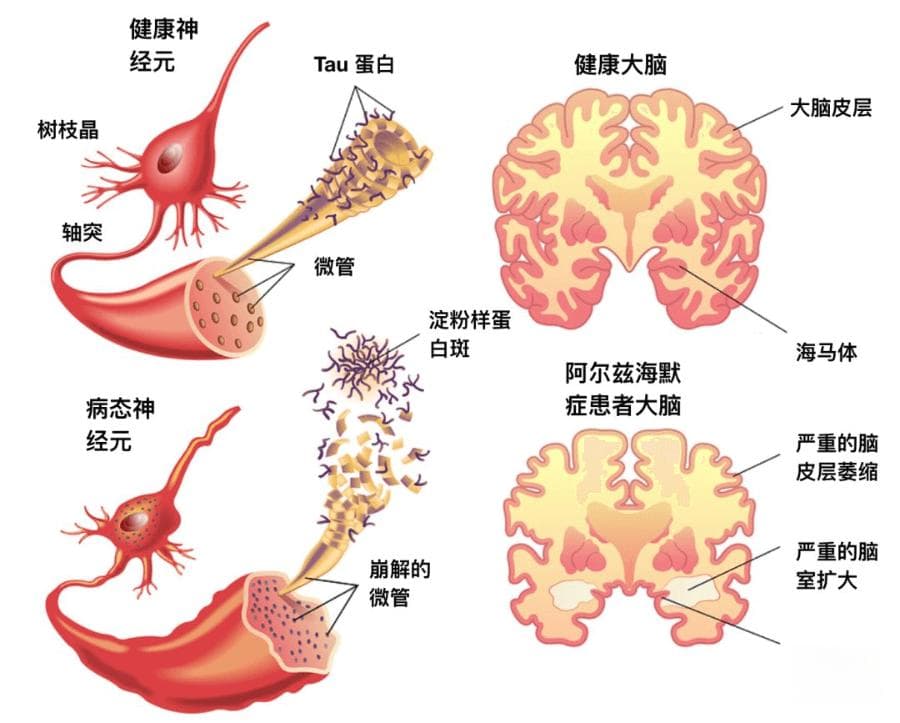 阿尔茨海默症的治疗新药｜仑卡奈单抗(Lecanemab）
