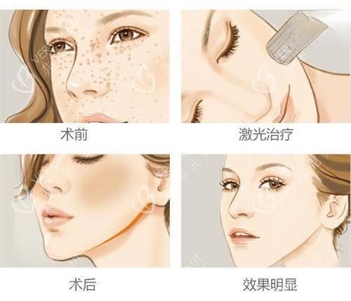 皮秒与激光祛斑对比：原理、效果及适用人群全解析