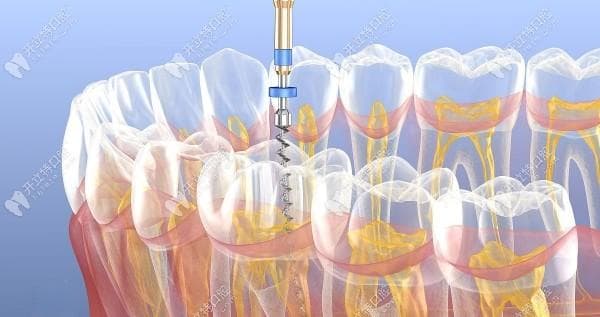 牙龈萎缩导致牙根外露怎么办？牙根外露挂牙周科做根管治疗