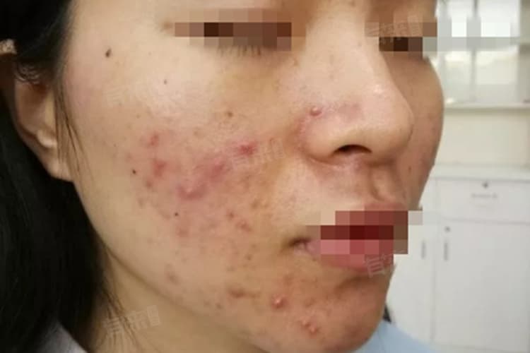 脸部皮肤下面有硬疙瘩怎么办？四种常见原因及处理方法