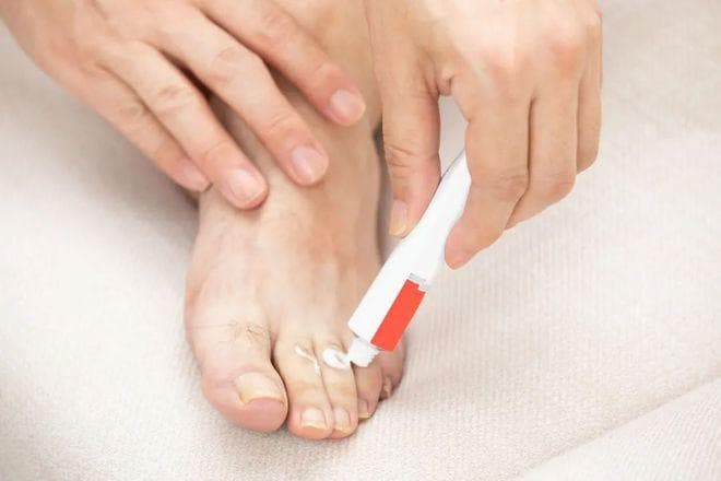 脚气的怎么来的，得了脚气应该注意哪些？