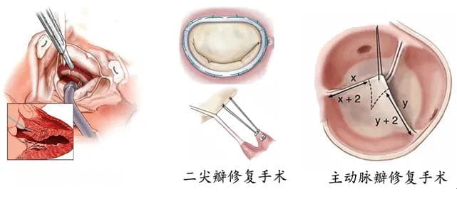 改良“Morrow”手术一次解决肥心病、二尖瓣和主动脉瓣关闭不全