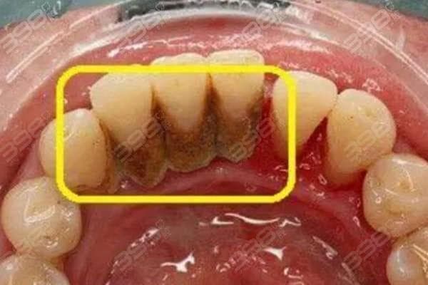 十几年不刷牙的危害与补救：从口腔到全身健康的全面解析