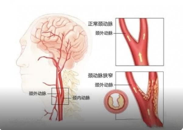 预防颈动脉狭窄 守护生命通道