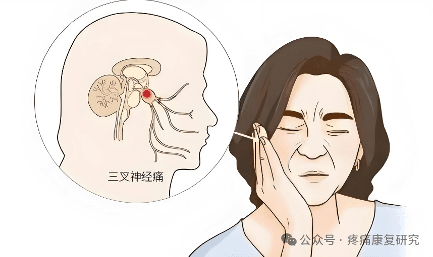 三叉神经痛：你不可不知的那些事儿