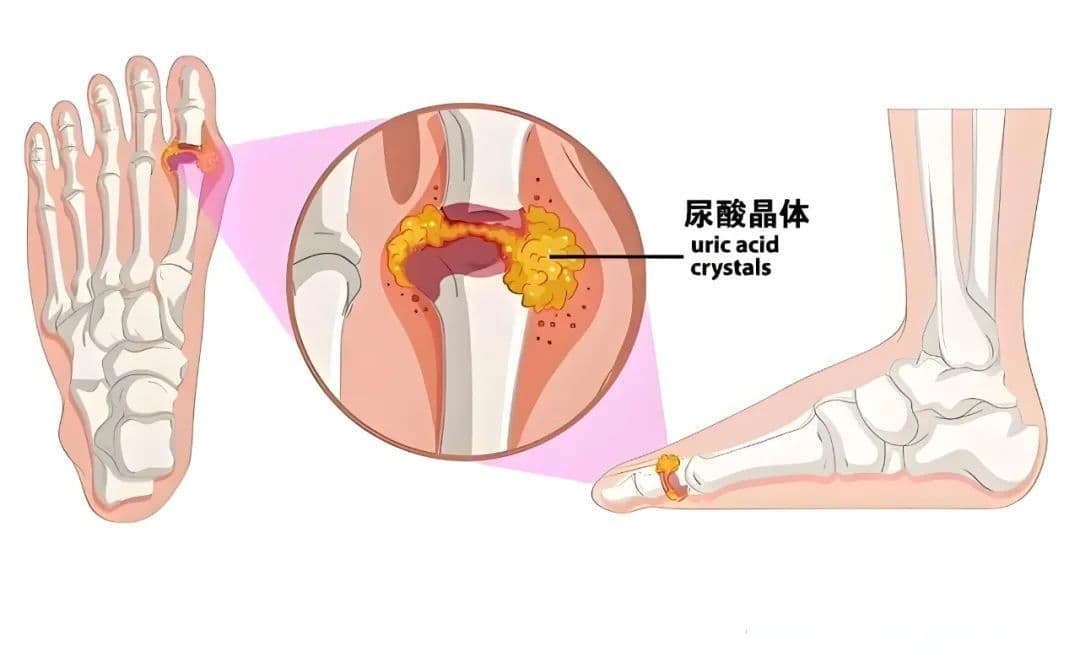 痛风治疗全攻略：从急性发作到稳定期管理