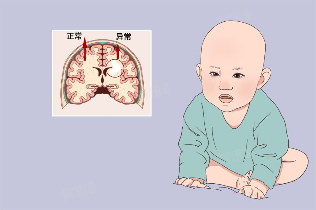 脑白质高信号的成因与治疗
