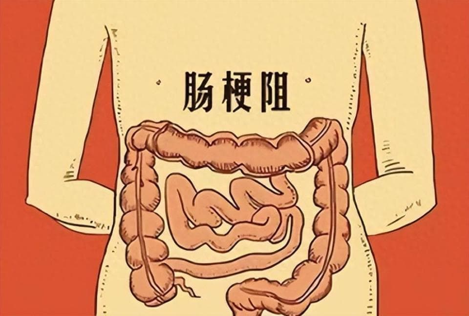 腹痛腹胀？呕吐？小心肠梗阻！这些原因易引发肠梗阻，治疗要趁早