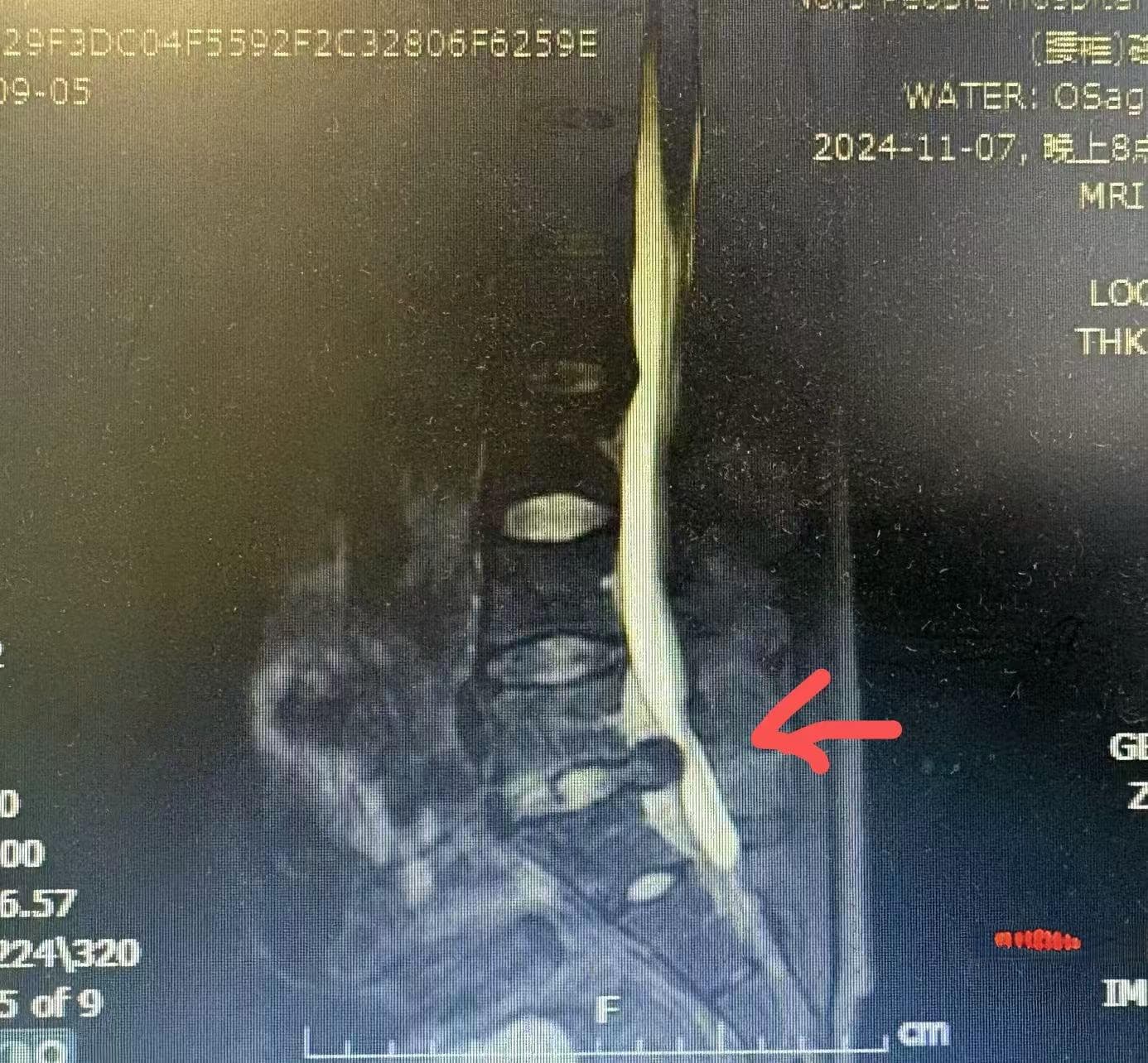 小针刀治疗腰椎间盘脱出：10分钟缓解疼痛，让患者重获轻松