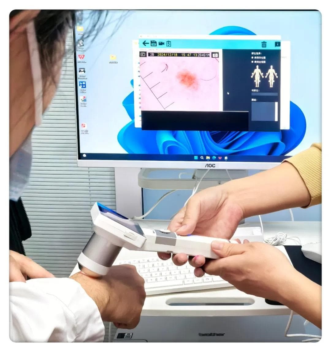 一文读懂儿童色素痣：从成因到处理方案