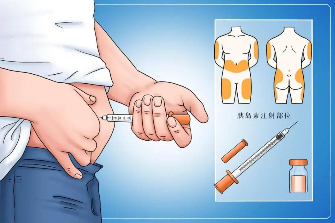老年糖尿病患者打胰岛素，有五个关键要点需注意，以确保安全有效使用