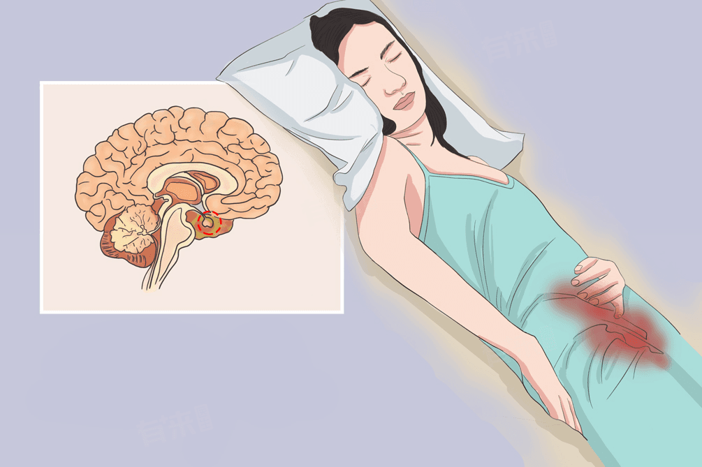席汉综合征是什么病？病因、症状及护理全解析