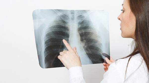 医生揭晓！肋骨下方隐痛这些原因你中招了吗？