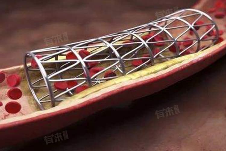 什么情况下要做心脏支架手术