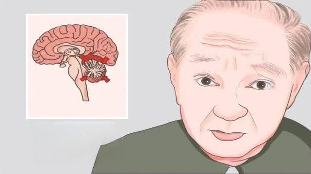 小脑共济失调的遗传概率有多高？一篇文章让你了解清楚