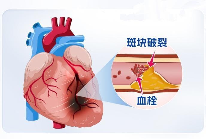 缓解压力，远离心梗：专家教你这么做